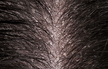 forfora shampoo rimedi naturali antiforfora