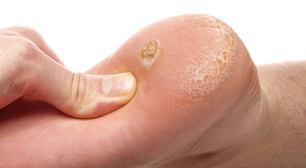 Calli e Vesciche ai Piedi: Cause, Rimedi Naturali e Trattamenti Efficaci