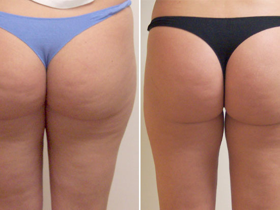 Come Combattere la Cellulite: Rimedi Naturali ed Efficaci per una Pelle Liscia