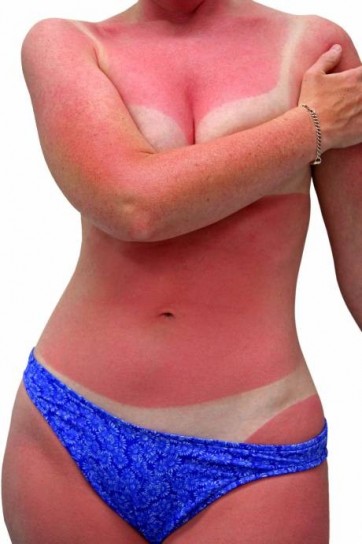 scottatura solare segno rimedi sole ustioni