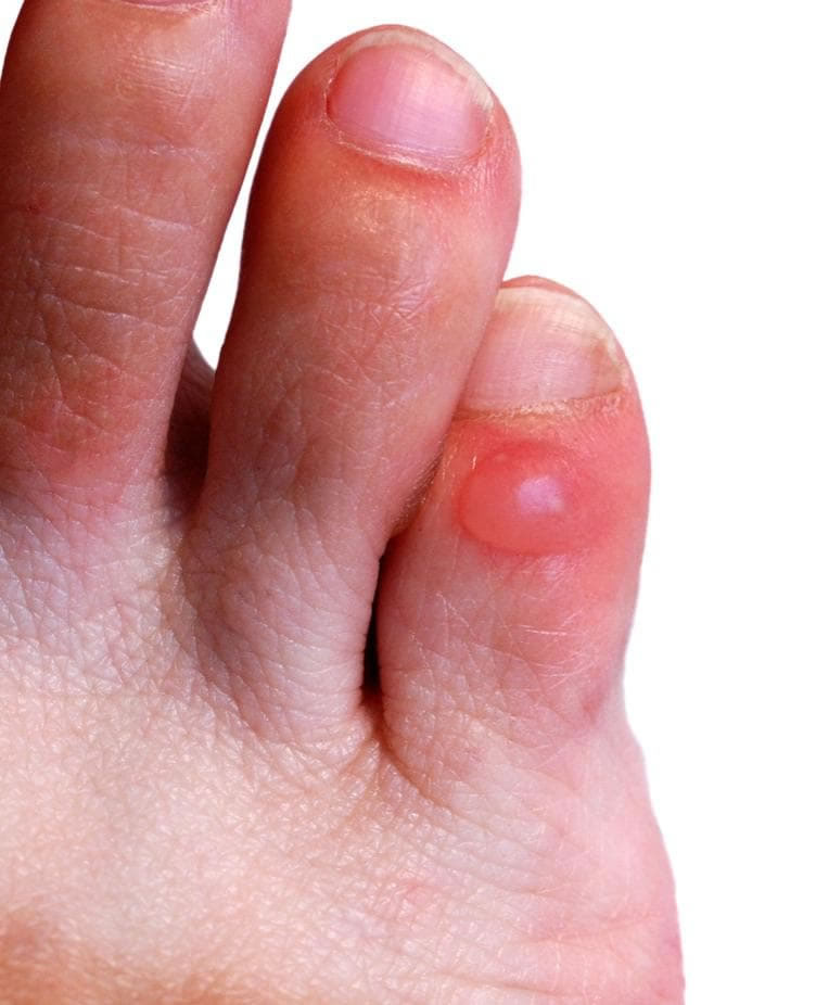 calli vesciche piedi rimedi naturali causa
