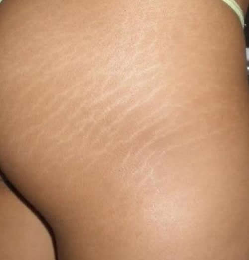 smagliatura gambe smagliatura
