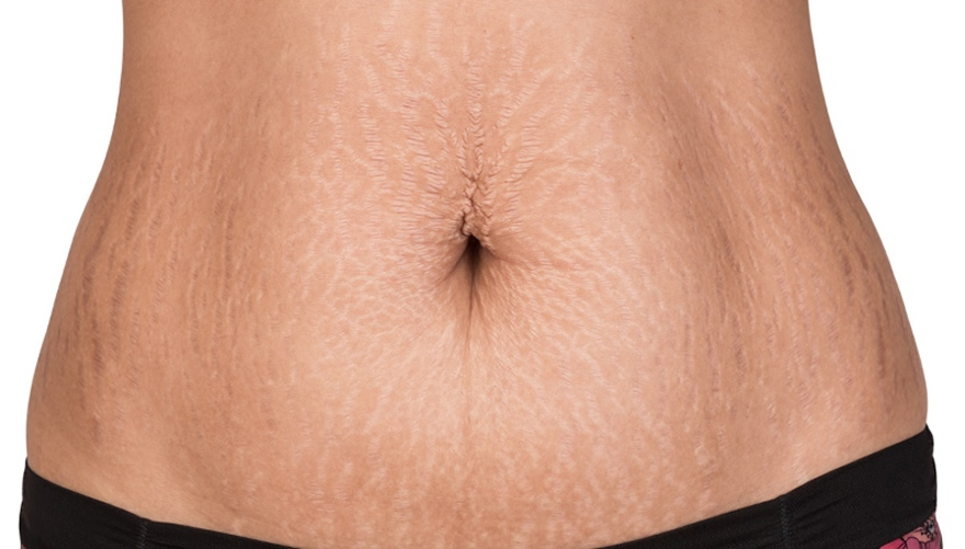 smagliatura pancia effetto rimedi